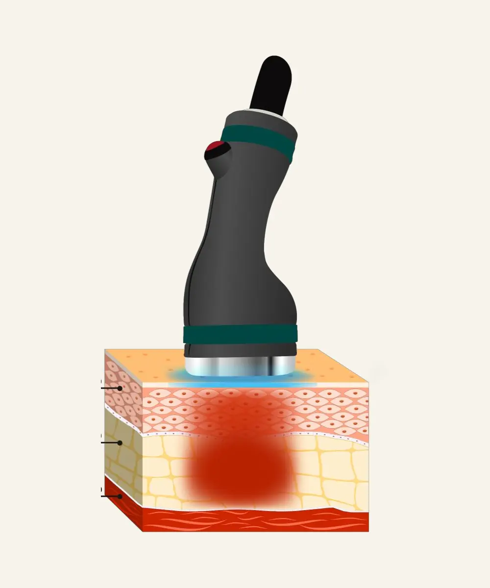 ONDA PRO Coolwaves能量作用於皮下脂肪層的示意圖